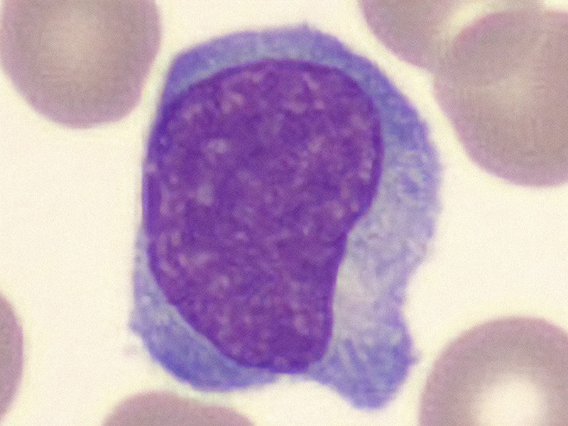 lymfocytose